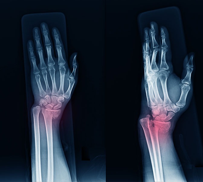 Bone Trauma Consultation