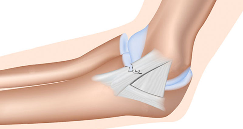 Elbow Ligament Consultation