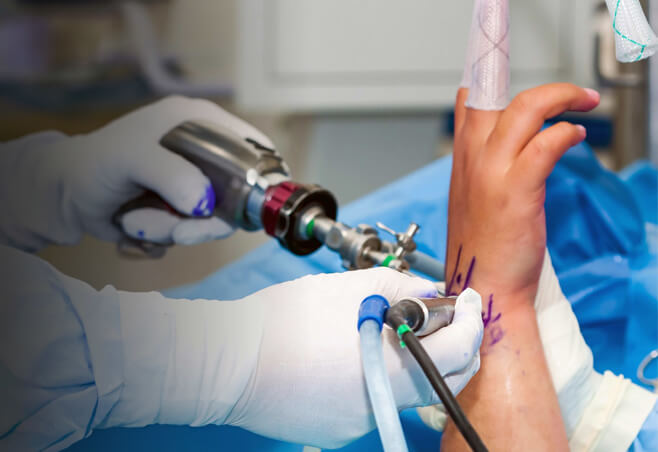 Wrist Arthroscopy