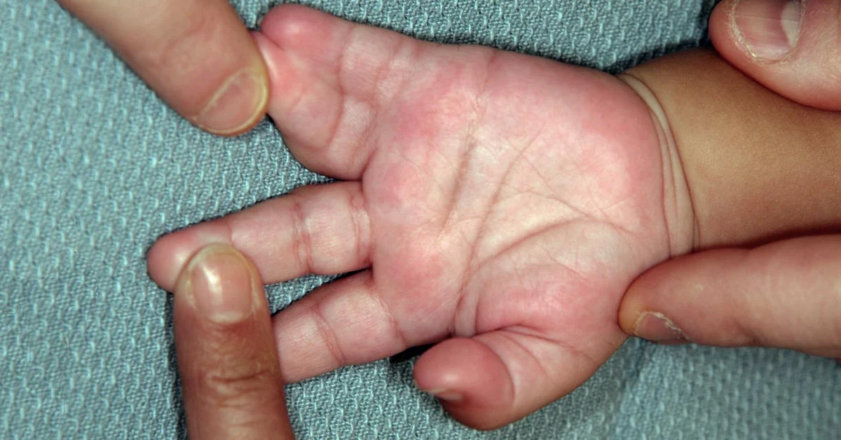 Congenital Hand Consultation